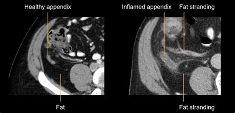 Abdominal CT: Common Terms • LITFL • Radiology library