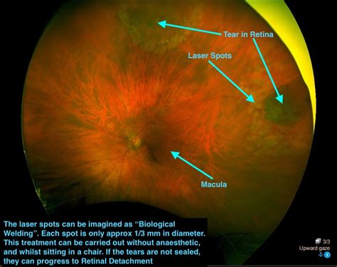 PVD & Retinal Tears