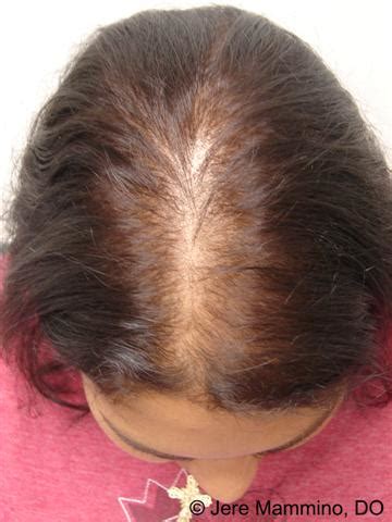 Female Pattern Hair Loss - American Osteopathic College of Dermatology (AOCD)