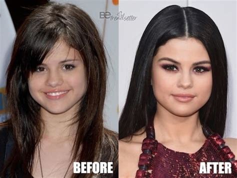 Selena Gomez All Plastic Surgery Revealed – Before and After Pictures | Glamour Path