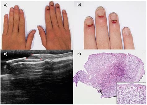 Pyogenic Granuloma Nail