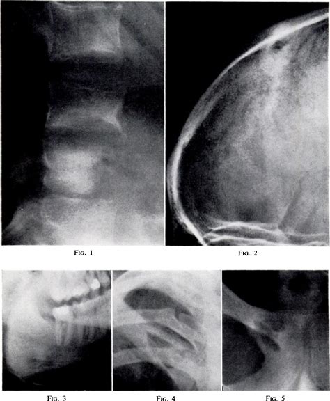 axillary abscess | Semantic Scholar