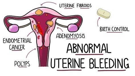 Abnormal Uterine Bleeding (AUB) - Menorrhagia & Heavy Menstrual Bleeding | (Including Mnemonic ...