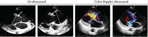 Echocardiography and computed tomography angiography findings for... | Download Scientific Diagram