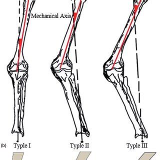 Varus Vs Valgus Fracture