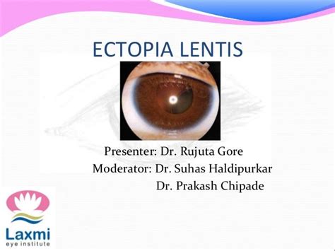 Ectopia lentis