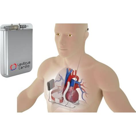 Implantable battery milestone toward Leviticus Cardio U.S. LVAD Trial