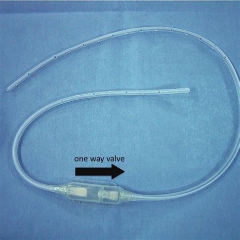 A pleuroperitoneal Denver® shunt catheter (arrows) positioned in the ...