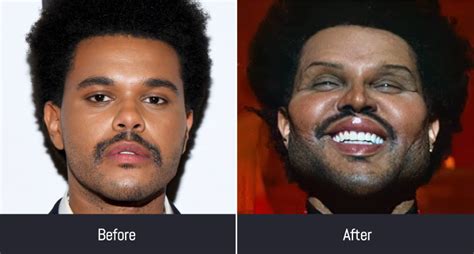 The Weeknd Before Plastic Surgery