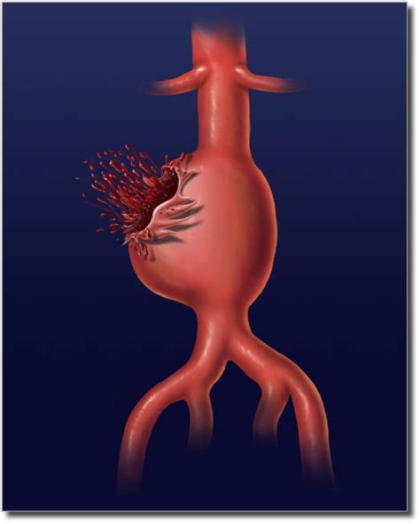 Abdominal aortic aneurysm Symptoms and causes Mayo Clinic