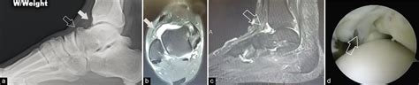 Is anterior and posterior ankle impingement under-diagnosed? A review - Journal of Arthroscopic ...