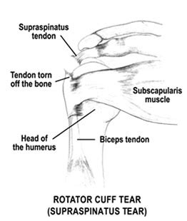 Understanding rugby shoulder injuries - Cape Shoulder Institute