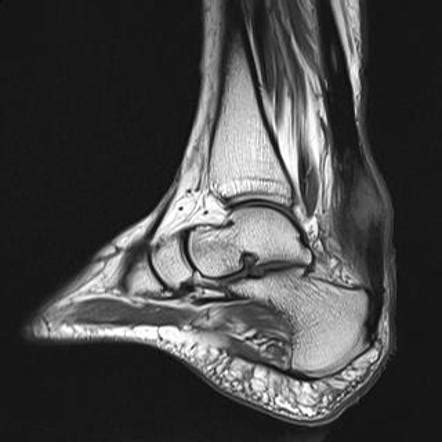 Insertional Achilles Tendonitis Mri