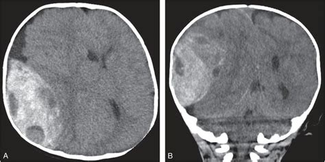 Abusive head trauma: extra-axial hemorrhage and nonhemic collections ...