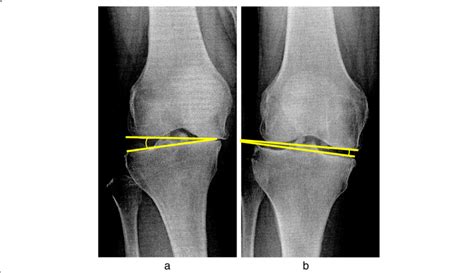 Varus and valgus stress angle. a: Varus and b: valgus stress were... | Download Scientific Diagram