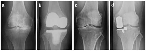 Rheumato | Free Full-Text | Short-Term Functional Outcomes of Unicompartmental versus Total Knee ...