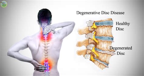 Degenerative Disk Disease - Orthopedic & Sports Medicine