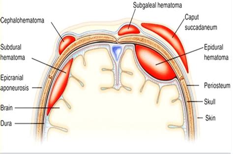 Medsea - #Subgaleal #hematoma Bloody collection in the...