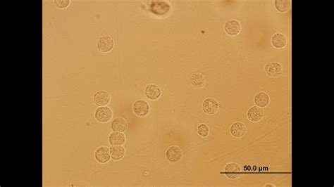 leukocytes in urine causes