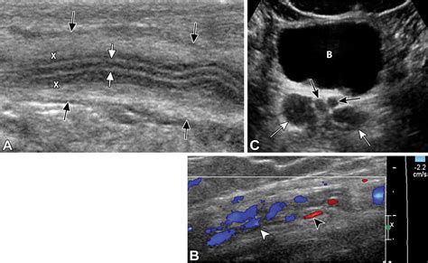 Pathologic Conditions at Imaging of the Spermatic Cord | RadioGraphics