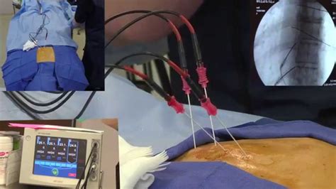 Radiofrequency Ablation Explanation Video Demonstration - LIVE! - YouTube