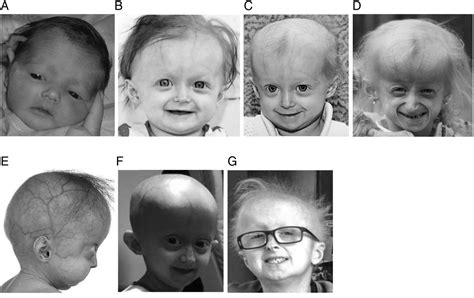 A novel somatic mutation achieves partial rescue in a child with Hutchinson-Gilford progeria ...