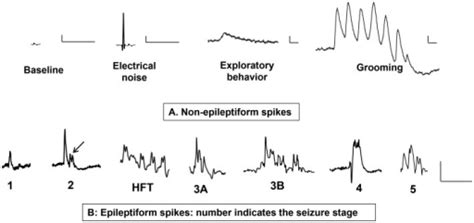 Individual spike characteristics on EEG.The baseline no | Open-i