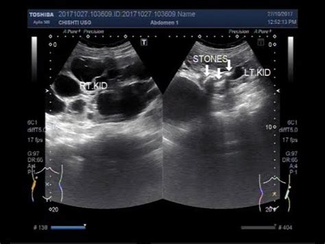 Ultrasound Video showing polycystic kidney disease. - YouTube