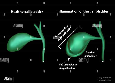 Symptoms of gallbladder inflammation. Cholecystitis. Thickening of the gallbladder wall ...