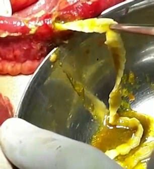 Stomach-churning footage shows surgeons removing a SIX FOOT-long worm from man's intestine ...