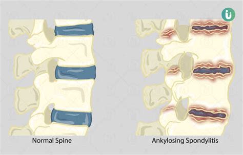 Spondylitis: symptoms, causes, treatment, medicine, prevention, diagnosis