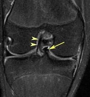 Bucket Handle Meniscal Tear on Knee MRI - radRounds Radiology Network