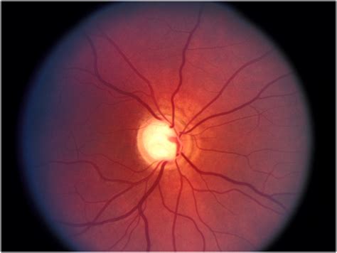 Specialty Eye Care What is a Glaucoma Specialist? - Specialty Eye Care