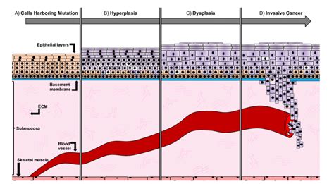 Developmental stages of squamous cell carcinoma. (A) The basement... | Download Scientific Diagram