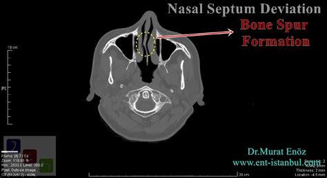 Treatment of Deviated Nasal Septum and Health Effects