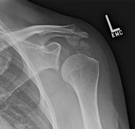 Calcific bursitis | Radiology Reference Article | Radiopaedia.org