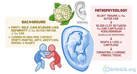 Cauliflower Ear: What Is It, Causes, Treatment, and More | Osmosis