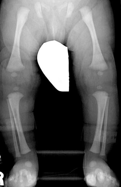 Cleidocranial dysplasia - wikidoc