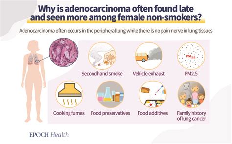 Lung Adenocarcinoma Symptoms Often Spotted at Late Stage, Treatment ...