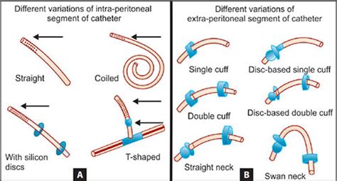 Peritoneal Dialysis Catheter Types