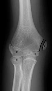 How to Avoid Missing a Pediatric Elbow Fracture - ACEP Now