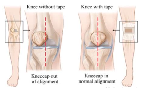 Patellar Malalignment Treatment | Knee Cap Malalignment Treatment in Pune, India