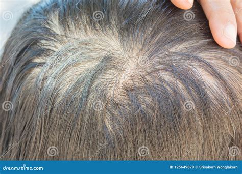 Thin hair and dandruff stock image. Image of care, back - 125649879