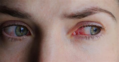 Pink Eye vs. Allergies: Causes, Symptoms, and Treatment