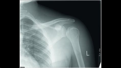 Post-Stroke Shoulder Subluxation: shoulder radiograph & clinical manifestation - YouTube