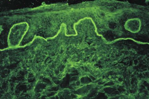 Epidermolysis bullosa acquisita