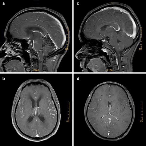 T1-weighted MRI sequence shows extensive enhancement of the... | Download Scientific Diagram