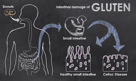 Coeliac disease Causes, Symptoms & Treatment -Clicks Health Hub