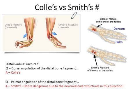 Colles Fracture Classification