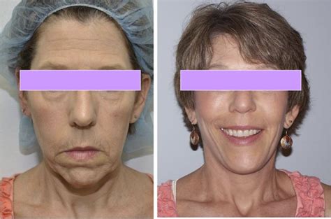 Neck Lift - Before and After. #cosmetic #makeover | Cosmetic surgery, Neck lift, Plastic surgery